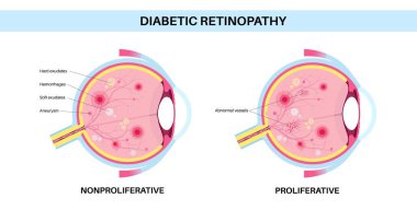 Diyabetik retinopati anatomisi. Sağlıklı göz ve hasarlı organ. İnsan gözü hastalığı, görme kaybı ya da körlük. Üretken ya da çoğaltıcı olmayan göz durumu. Retina tıbbi düz vektör çizimi