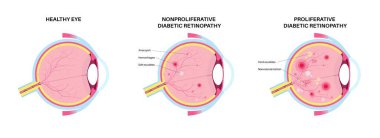 Diyabetik retinopati anatomisi. Sağlıklı göz ve hasarlı organ. İnsan gözü hastalığı, görme kaybı ya da körlük. Üretken ya da çoğaltıcı olmayan göz durumu. Retina tıbbi düz vektör çizimi