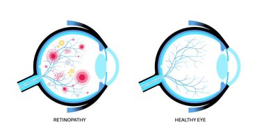 Diyabetik retinopati anatomisi. Sağlıklı göz ve hasarlı organ. İnsan gözü hastalığı, görme kaybı ya da körlük. Üretken ya da çoğaltıcı olmayan göz durumu. Retina tıbbi düz vektör çizimi