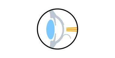 Lazer göz ameliyatı ikonu. Görüş bozukluğu, miyopluk, miyopluk ve astigmatizm sorunları. Acısız bir işlem korneayı, insan gözü anatomik düz vektör çizimini yeniden şekillendirir.