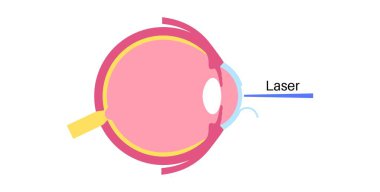 Lazer göz ameliyatı. Miyopluk, miyopluk, miyopluk ve astigmatizm gibi görüş sorunlarının düzeltilmesi. Acısız bir işlem korneayı, insan gözü anatomik düz vektör çizimini yeniden şekillendirir.