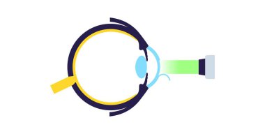 Lazer göz ameliyatı. Miyopluk, miyopluk, miyopluk ve astigmatizm gibi görüş sorunlarının düzeltilmesi. Acısız bir işlem korneayı, insan gözü anatomik düz vektör çizimini yeniden şekillendirir.