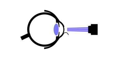 Lazer göz ameliyatı ikonu. Görüş bozukluğu, miyopluk, miyopluk ve astigmatizm sorunları. Acısız bir işlem korneayı, insan gözü anatomik düz vektör çizimini yeniden şekillendirir.