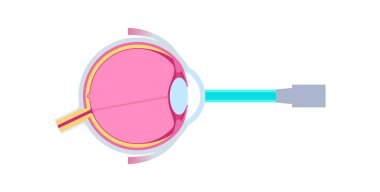 LASIK laser eye surgery. Correction of vision issues like nearsightedness, farsightedness, and astigmatism. Safe painless procedure reshapes the cornea, human eye anatomical flat vector illustration clipart