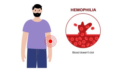 Hemofili genetik bozukluğu, zayıf kan pıhtılaşması. Doğuştan kanama hastalığı. Eksik, azalmış ya da işlevsiz pıhtılaşma faktörü. Kalıtsal kan bozukluğu, genetik mutasyon vektör çizimi