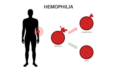 Hemofili genetik bozukluğu, zayıf kan pıhtılaşması. Doğuştan kanama hastalığı. Eksik, azalmış ya da işlevsiz pıhtılaşma faktörü. Kalıtsal kan bozukluğu, genetik mutasyon vektör çizimi
