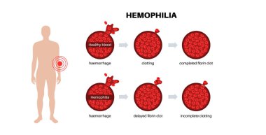 Hemofili genetik bozukluğu, zayıf kan pıhtılaşması. Doğuştan kanama hastalığı. Eksik, azalmış ya da işlevsiz pıhtılaşma faktörü. Kalıtsal kan bozukluğu, genetik mutasyon vektör çizimi