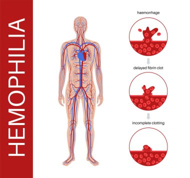Hemofili genetik bozukluğu, zayıf kan pıhtılaşması. Doğuştan kanama hastalığı. Eksik, azalmış ya da işlevsiz pıhtılaşma faktörü. Kalıtsal kan bozukluğu, genetik mutasyon vektör çizimi