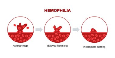 Hemophilia genetic disorder, poor blood clotting. Congenital bleeding disease. Absent, decreased or dysfunctional coagulation factor. Inheritance blood disorder, genetic mutation vector illustration clipart