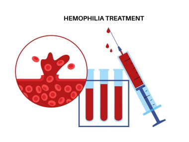 Hemophilia genetic disorder, poor blood clotting. Hemostatic support, adjunctive therapy, prophylaxis and inhibitor management. Dysfunctional coagulation factor genetic mutation vector illustration