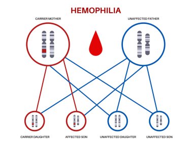 Hemofili genetik bozukluğu, zayıf kan pıhtılaşması. Röntgen bağlantılı resesif kalıtsal kanama hastalığı. Bozuk pıhtılaşma faktörü genetik mutasyon vektörü çizimi