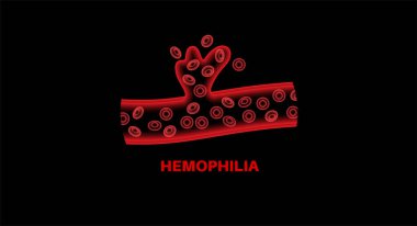 Hemofili genetik bozukluğu, zayıf kan pıhtılaşması. Doğuştan kanama hastalığı. Eksik, azalmış ya da işlevsiz pıhtılaşma faktörü. Kalıtsal kan bozukluğu genetik mutasyon 3 boyutlu vektör çizimi