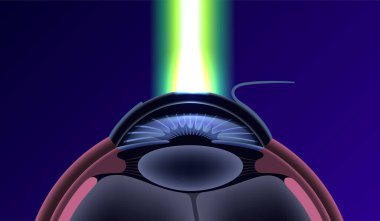 Lazer göz ameliyatı posteri. Görüş bozuklukları, miyopluk, miyopluk, astigmatizm. Acısız bir işlem, korneayı yeniden şekillendirir, insan gözü anatomik 3D vektör tıbbi illüstrasyon