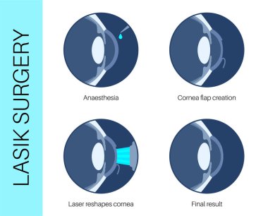 Lazer göz ameliyatı işlemi. Görüş bozuklukları, miyopluk, miyopluk, astigmatizm. Acısız işlem kornea insan gözü anatomik poster düz vektör çizimini yeniden şekillendirir.