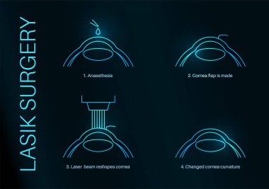 Lazer göz ameliyatı işlemi. Görüş bozuklukları, miyopluk, miyopluk, astigmatizm. Güvenli acısız işlem kornea insan gözü anatomik poster çizimini yeniden şekillendirir.