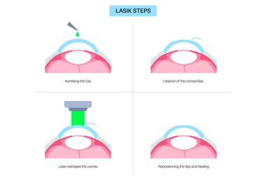 LASIK laser eye surgery process. Correction of vision issues nearsightedness, farsightedness, astigmatism. Safe painless procedure reshapes cornea human eye anatomical 3D realistic vector illustration clipart