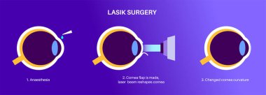 LASIK laser eye surgery process. Correction of vision issues nearsightedness, farsightedness, astigmatism. Safe painless procedure reshapes cornea human eye anatomical poster flat vector illustration clipart