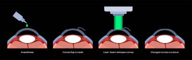 LASIK laser eye surgery process. Correction of vision issues nearsightedness, farsightedness, astigmatism. Safe painless procedure reshapes cornea human eye anatomical poster flat vector illustration clipart