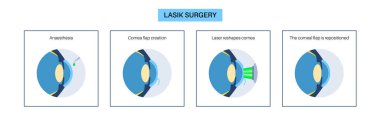 LASIK laser eye surgery process. Correction of vision issues nearsightedness, farsightedness, astigmatism. Safe painless procedure reshapes cornea human eye anatomical poster flat vector illustration clipart