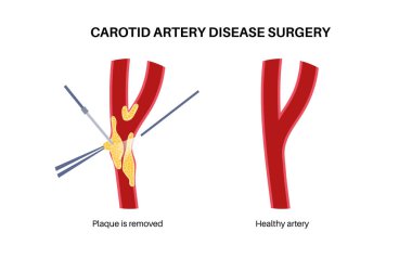 Şah damarı hastalığı ameliyatı. Engellenmiş arterlerden kolesterol, yağ ve kalsiyum plaklarını çıkarın. İnsan boynundaki ve beynindeki damarlar. Felç riski, vasküler sorunlu tedavi vektör çizimi