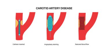 Şah damarı anjiyoplasti ve stent ameliyatı. Normal kan akışını onar. Kolesterol, yağ ve kalsiyum plaka boyun ve beyinde tıkanmış arter. Vasküler sorun tedavi vektörü çizimi