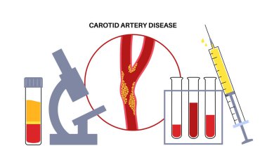 Şah damarı hastalığı. Laboratuvarda muayene. Kolesterol, yağ ve kalsiyum plakla tıkanmış arterler. İnsan boynundaki ve beynindeki damarlar. Kan pıhtısı ve inme riski, damar problemi çizimi
