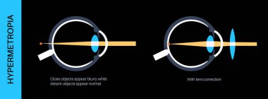 Uzaklık merceği düzeltme posteri. Hiperopya ya da uzun görüş kırılma hatası konsepti, bulanık görme sorunu. İnsan gözü ve retina anatomisi, hipermetrop tıbbi vektör çizimi