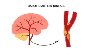 Şah damarı hastalığı. Kolesterol, yağ ve kalsiyum plakla tıkanmış arterler. İnsan boynundaki ve beynindeki damarlar. Kan pıhtısı ve felç riski, vasküler sağlık sorunu düz vektör çizimi