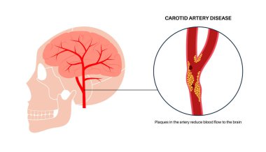 Şah damarı hastalığı. Kolesterol, yağ ve kalsiyum plaketi arteri tıkamış. İnsan boynundaki damarlar, beyin anatomisi. Kan pıhtısı ve felç riski, vasküler sağlık sorunu düz vektör çizimi