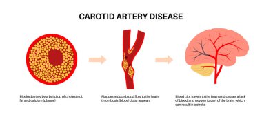 Şah damarı hastalığı. Kolesterol, yağ ve kalsiyum plaketi arteri tıkamış. İnsan boynundaki damarlar, beyin anatomisi. Kan pıhtısı ve felç riski, vasküler sağlık sorunu düz vektör çizimi