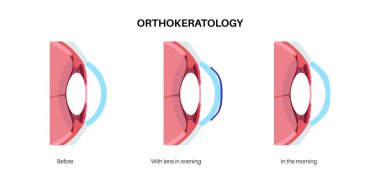 Ortoeratoloji lens takıyordu. Görüşü iyileştirmek için korneayı yeniden şekillendir. Ortopedi, miyop ya da miyop. Kornea ve retina anatomisi, insan gözü hastalığı tedavisi düz vektör çizimi.