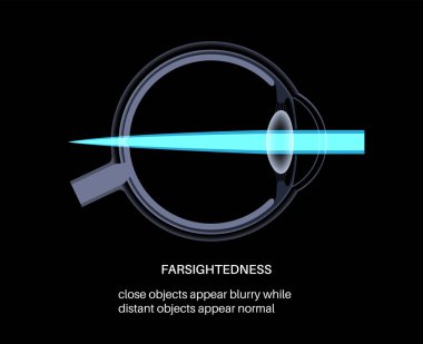 Farsightedness eye disease poster. Hyperopia or long sightedness refractive error concept, problem of blurred vision. Anatomy of human eye, lens and retina, hypermetropia medical vector illustration clipart