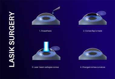 LASIK laser eye surgery process. Correction of vision issues nearsightedness, farsightedness, astigmatism. Safe painless procedure reshapes cornea human eye anatomical 3D realistic vector illustration clipart