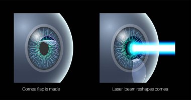 LASIK laser eye surgery 3D poster. Correction of vision issues nearsightedness, farsightedness, astigmatism. Safe painless procedure, reshapes cornea, human eye anatomical vector medical illustration clipart