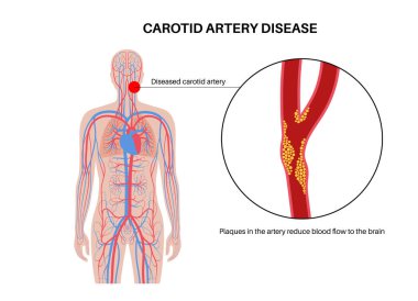 Şah damarı hastalığı. Kolesterol, yağ ve kalsiyum plakla tıkanmış arterler. İnsan boynundaki ve beynindeki damarlar. Kan pıhtısı ve felç riski, vasküler sağlık sorunu düz vektör çizimi