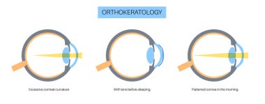 Ortoeratoloji lens takıyordu. Görüşü iyileştirmek için korneayı yeniden şekillendir. Ortopedi, miyop ya da miyop. Kornea ve retina anatomisi, insan gözü hastalığı tedavisi düz vektör çizimi.