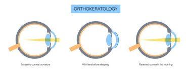 Orthokeratology fitted contact lens. Reshape the cornea to improve vision. Ortho k correct nearsightedness or myopia. Cornea and retina anatomy, human eye disease treatment flat vector illustration. clipart