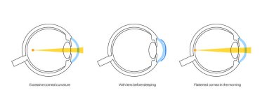 Ortoeratoloji lens takıyordu. Görüşü iyileştirmek için korneayı yeniden şekillendir. Ortopedi, miyop ya da miyop. Kornea ve retina anatomisi, insan gözü hastalığı tedavisi düz vektör çizimi.