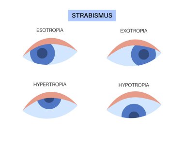 Strabismus göz hastalığı konsepti. Göz hizası bozukluğu, esotropia ve egzotropi gibi durumları vurgulamak. Hipertropi ve hipotropi. Dürbün görme sorunları, teşhis ve tedavi vektörü çizimi