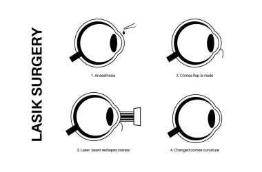 LASIK laser eye surgery. Correction of vision issues nearsightedness, farsightedness, and astigmatism. Safe painless procedure reshapes the cornea, human eye anatomical outline vector illustration clipart