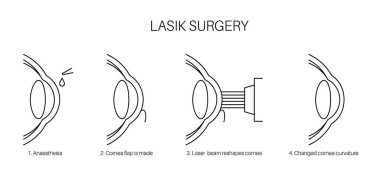 Lazer göz ameliyatı. Görüş bozukluğu, miyopluk, miyopluk ve astigmatizm sorunları. Güvenli acısız işlem korneayı, insan gözü anatomik çizim çizelgesini yeniden şekillendirir.