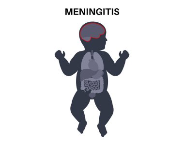 Meningitis inflammation of the protective layers surrounding the brain and spinal cord. Meninges disease medical poster. Bacteria, viruses, fungi, parasites in the baby head flat vector illustration clipart