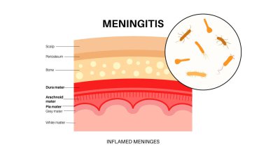 Meningitis inflammation of the protective layers surrounding the brain and spinal cord. Structure of meninges, headache diagnosis and treatment. Bacteria, viruses and fungi in the human head vector clipart