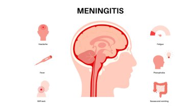 Beyni ve omuriliği çevreleyen koruyucu tabakalarda menenjit iltihabı. Meninges hastalığı tıbbi posteri. Baş ağrısı, boyun tutulması, kusma ve ateş düz vektör çizimi.