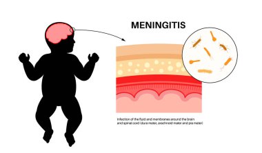 Beyni ve omuriliği çevreleyen koruyucu tabakalarda menenjit iltihabı. Meninges hastalığı tıbbi posteri. Bakteriler, virüsler, mantarlar, parazitler bebek kafası düz vektör illüstrasyonunda