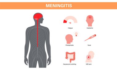 Beyni ve omuriliği çevreleyen koruyucu tabakalarda menenjit iltihabı. Meninges hastalığı tıbbi posteri. Baş ağrısı, boyun tutulması, kusma ve ateş düz vektör çizimi.
