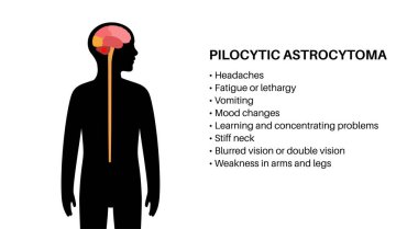 Pilocytic astrocytoma symptoms. Slow growing type of primary central nervous system tumor. Cerebellum disease. Neoplasm in the child silhouette. Problems with balance, coordination, and optic nerve clipart