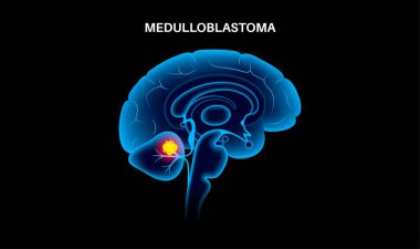 Medulloblastoma medical poster. Cancerous brain tumor in children. Cerebellum disease concept. Neoplasm in the child silhouette. Problem with balance, coordination, and optic nerve vector illustration clipart