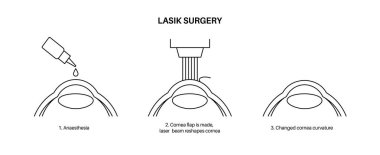 Lazer göz ameliyatı. Görüş bozukluğu, miyopluk, miyopluk ve astigmatizm sorunları. Güvenli acısız işlem korneayı, insan gözü anatomik çizim çizelgesini yeniden şekillendirir.