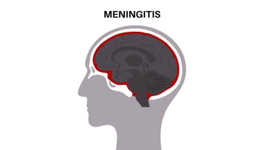 Beynin koruyucu katmanları ve omuriliğinde menenjit akut ya da kronik iltihaplanma. Meninges hastalığı posteri. Bakteriler, virüsler, mantarlar, parazitler insan kafası düz vektör illüstrasyonunda